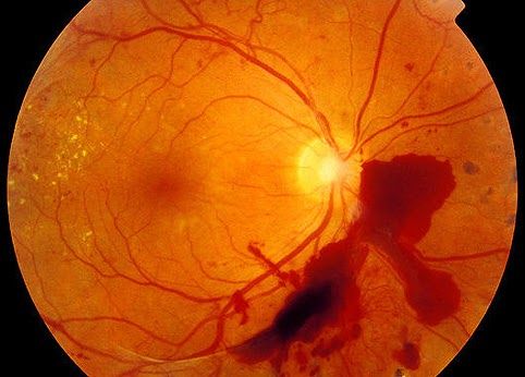 Retina damage from diabetes. Ophthalmoscope image of diabetic retinopathy, where severe damage to the retina has been caused by diabetes. Red blood vessels are seen emerging from the yellow optic disc (right). The red patch is a serious haemorrhage, where blood has leaked from blocked capillaries. This has caused a reduction in blood flow to other areas of the retina, leading to the proliferative growth of new capillaries (left). The yellow patches (left) are fatty exudates, caused by the increased permeability of blood vessels. Diabetic retinopathy may lead to blindness if left untreated. Bleeding can be treated by laser photocoagulation, and blood sugar level maintenance can slow the disease's progress.